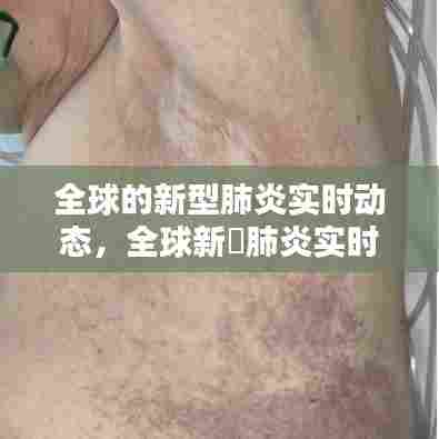 全球的新型肺炎实时动态,全球新冦肺炎实时报告