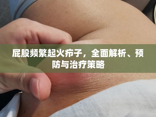 屁股频繁起火疖子,全面解析、预防与治疗策略